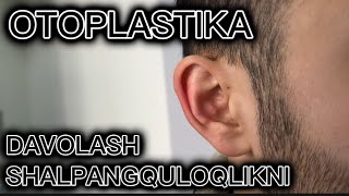 OTOPLASTIKA SHALPANGQULOQLIKNI DAVOLASH [upl. by Suez167]