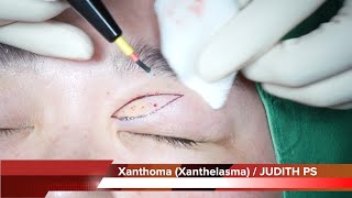 Xanthoma Xanthelasma removal surgery 안검황색종 [upl. by Poppo]