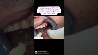 تركيب جسر زيركون لسن مفقود zirconbridge [upl. by Nnyltak386]