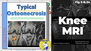 Fig 5B34 Typical Osteonecrosis [upl. by Jezrdna238]