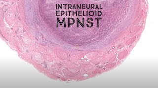 Intraneural epithelioid MPNST malignant peripheral nerve sheath tumorAustralasian Dermpath Case 12 [upl. by Kondon]