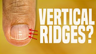 Uncovering the True Reasons Behind Vertical Ridges on Your Nails [upl. by Riccio789]