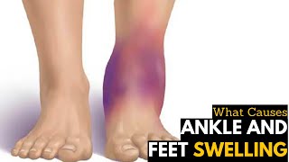 What Causes Ankles amp Feet Swelling  Diagnosis amp Treatment [upl. by Illehs]