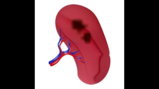 Splenic infarction  Spleen Infarction  Definition Causes Symptoms Diagnosis Treatment [upl. by Adni224]