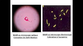 06Tuberculose extrapulmonaire TEP Pr Yahaoui Beni Messousse  Pneumo [upl. by Eseerahs]