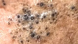 Blackheads Satisfying Removal 0003 [upl. by Ainnek]