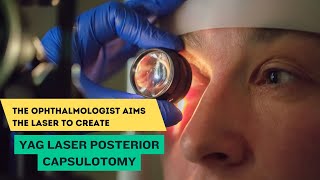 YAG Laser Posterior Capsulotomy [upl. by Aivataj]