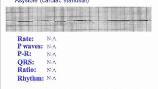 ECG Asystole [upl. by Airrotal]