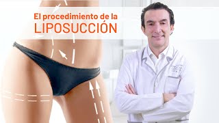 Cómo se hace el Tratamiento de Liposucción 3D [upl. by Aihtenyc]