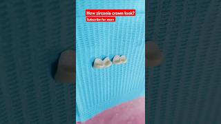 zirconia crown  artificial natural looking teeth  dental shorts asmr viral viralshorts [upl. by Ahcsat]