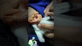 Keloid Scar  Triamcinolone Injection short shorts [upl. by Nguyen]