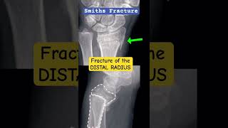 Wrist Fracture  Smiths fracture of the Distal Radius🩻🦴 shorts radiology doctor [upl. by Zerdna]