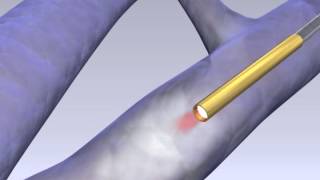 VenaCure EVLT Laser Vein Treatment with the NeverTouch Fibre [upl. by Eleph]