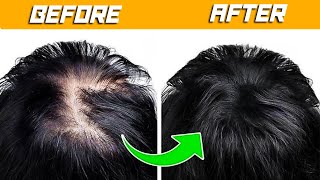 13 Natural Methods to Regrow Your Hair and Say Goodbye to Bald Spots [upl. by Carilla]