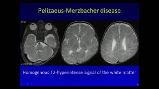 Leukodystrophies and Leukoencephalopaties  Andrea Poretti MD [upl. by Lachance]