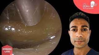 1222  Massively Blocked Ear Wax Removal [upl. by Nila]