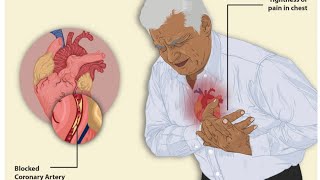 Anti anginal Drugs amp what is angina how to know it [upl. by Laflam]