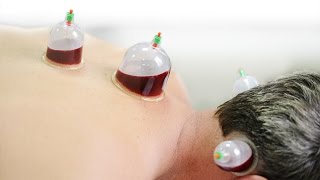 Hijama Treatment Wet and Dry Cupping Therapy [upl. by Bainter]