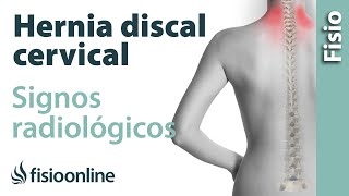 Hernia discal cervical  Signos radiológicos [upl. by Dralliw]