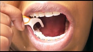 Flossing with Braces  My Nightly Routine  6 Week Adult Braces Update [upl. by Yuht]