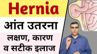 Hernia Symptoms  Hernia Ke Lakshan  Hernia ka Ilaaj  Hernia Treatment Without Surgery [upl. by Templer766]