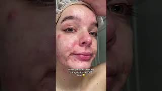 Coming to terms with my acne on my skin healing journey realskin [upl. by Rego939]