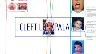 CLEFT LIPPALATE [upl. by Aziza94]