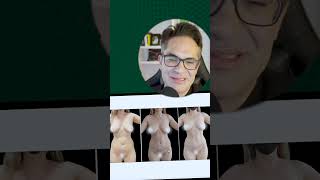 Lipo Abdominoplastia 360  Cirurgia plástica [upl. by Nameloc]