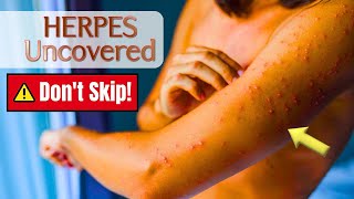 Herpes Uncovered Treatments Research and Hope for a Cure herpes herpesawareness [upl. by Arev443]