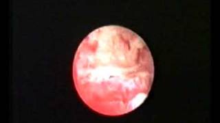 hysteroscopic treatment of osteoid metaplasia [upl. by Nylqcaj491]