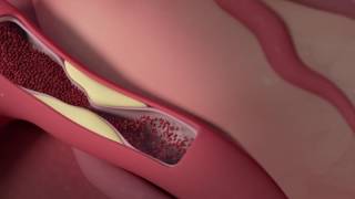 What is a coronary angiogram [upl. by Eltrym]