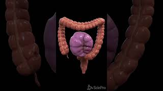 Understanding Colon Volvulus A Twist in the Digestive Tale [upl. by Anaicilef]