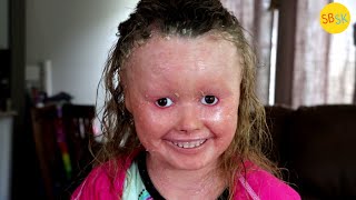 Living with Harlequin Ichthyosis Skin that Grows 10x Too Fast [upl. by Dettmer]