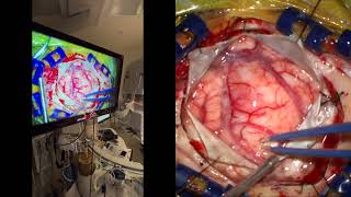 Awake craniotomy Resection of tumor invading center of Compassion and Kindness with compassion [upl. by Olds]