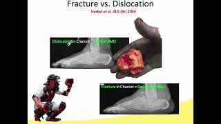 Midfoot Charcot Treatment Options and Considerations [upl. by Tersina]