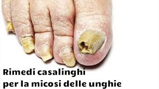 Facili Rimedi Casalinghi Per La Micosi Delle Unghie Fungo alle Unghie [upl. by Keener]