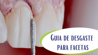 Guia de desgaste para preparo de facetas [upl. by Napier547]