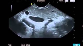 Endosonography in Autoimmune Pancreatitis [upl. by Turk]