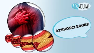 ATEROSCLEROSE O QUE É CAUSAS SINTOMAS FATORES DE RISCO TRATAMENTO E PREVENÇÃO [upl. by Aurelius]