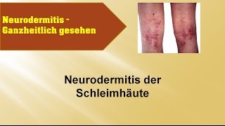 Neurodermitis der Schleimhäute  GANZMEDIZIN Naturheilpraxis [upl. by Eanerb261]