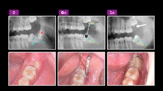 Lower Impacted Molar with Ramus Screw amp aligner｜【Chris Chang Ortho】CC759 [upl. by Sorensen]