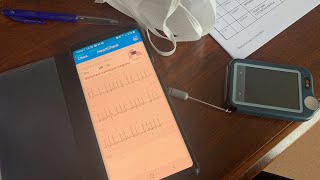 Extrasystoles arythmie Enregistreur d’événement VS smartwatch [upl. by Casie]