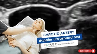 Carotid artery Doppler ultrasound test Accurate examination to perform a basic ultrasound carotid [upl. by Vladimar]