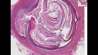 Histopathology SkinEpidermal inclusion cyst [upl. by Aramit]