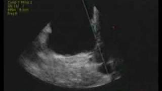 intracardiac echocardiography ICE [upl. by Nrojb]