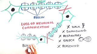 WHAT IS MLD Metachromatic Leukodystrophy explained to all [upl. by Zeni]