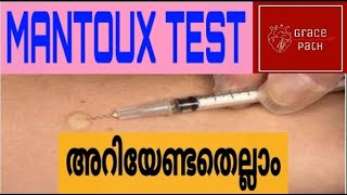 Mantoux Test  Tuberculin Skin Test TST Malayalam [upl. by Nayek]