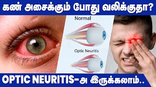 Optic Neuritis  Causes Symptoms amp Treatments  Health Tips [upl. by Aerdied]