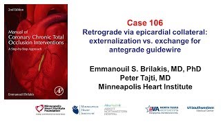 Case 106 Manual of CTO interventions Retrograde via epicardial collateral [upl. by Uhile183]