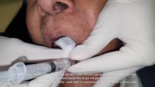 intraligamentary local anaesthesia technique by using conventional syringe by dr nishit kumar shah [upl. by Apfel]